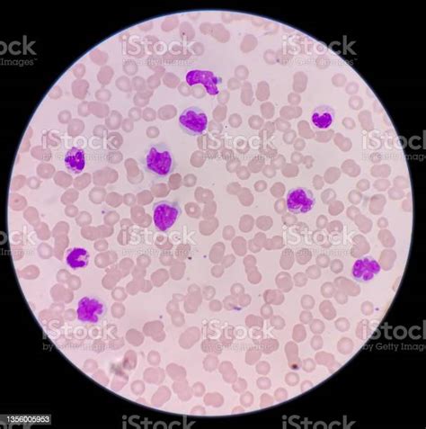 Microscopic Image Showing Thrombocytopenia With Leukocytosis Monocytes