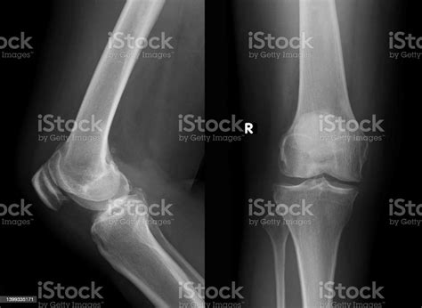 Osteoarthritis Knee Film Xray Knee Stock Photo Download Image Now