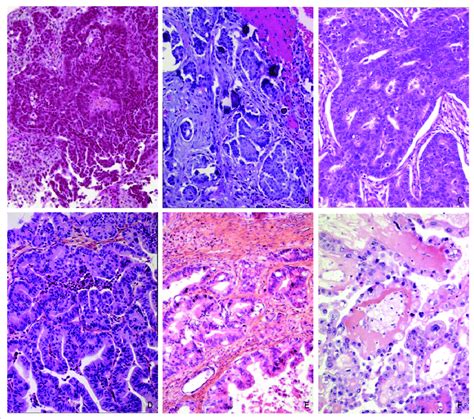 Serous Ovarian Cancer Histology Cancerwalls