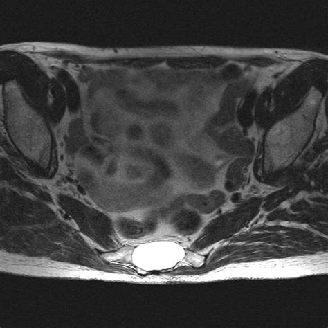 A Cyst In The Sacrum Bmj Case Reports