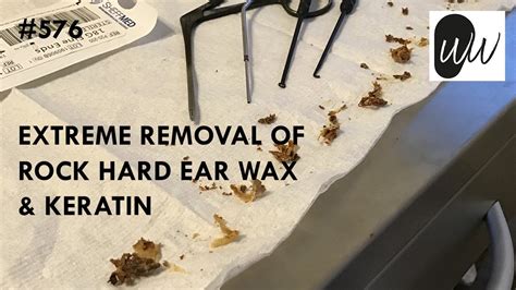 576 Extreme Removal Of Rock Hard Ear Wax And Keratin Youtube