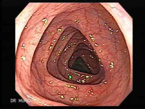 Colon (config.sys directive) , usage of. Blog » KEC Endo | Kalamazoo Endo Center | Just another ...