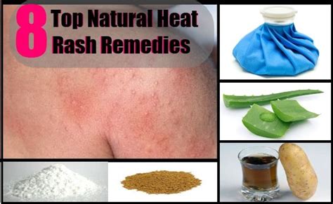8 Top Natural Heat Rash Remedies Rashes Remedies Heat Rash Heat