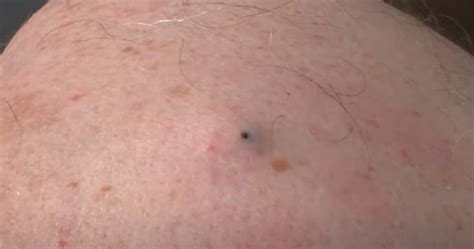 Huge Blackhead On The Back Removed New Pimple Popping Videos