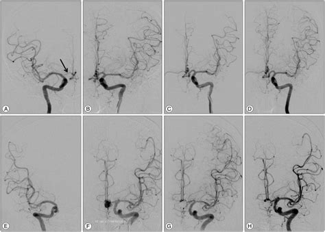 Eleven Year S Single Center Experience Of Endovascular Treatment Of Anterior Communicating