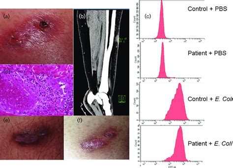 A Nodular Inflammatory Lesion Of The Left Leg At Admission One Month