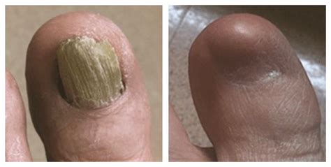 Surgical Removal Of A Painful Toenail Dr Nicholas Campitelli