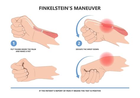 De Quervain S Tenosynovitis Complete Physio