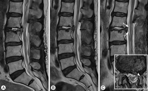 Figure 6clinical And Radiological Findings Of Nerve Root Herniation