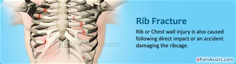 Broken Rib Causes Signs Symptoms Recovery Time Treatm