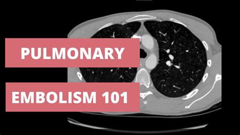 How To Identify A Pulmonary Embolism On Ct Search Pattern For Cta