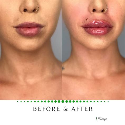 Lip Filler Before And After Lip Fillers Cost Lip Fillers Aesthetic