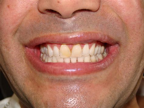 Teeth Whitening And Veneers Barrie Dr Dove Dental Office