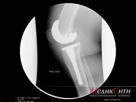 Диета от артроза 1 степени