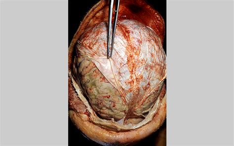 Pneumococcal Disease Photos Of Bacteria And People