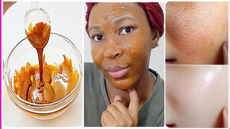 The Secret Remedy They Never Talk About Remove Hyper Pigmentation On