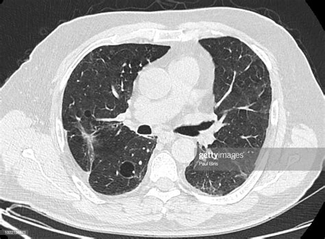 Pulmonary Emphysema Seen On Axial Lung Ct High Res Stock Photo Getty