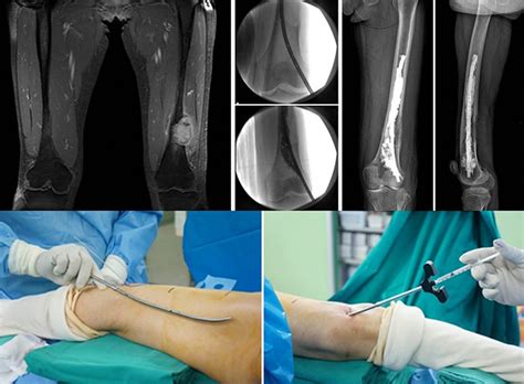 Minimal Invasive Surgery Of Metastatic Bone Tumor Intechopen