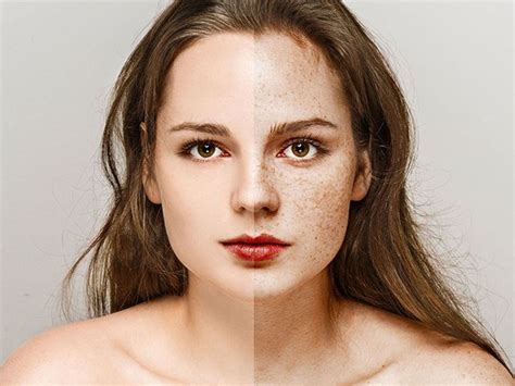 10 Incredible Home Remedies To Remove Freckles On Face