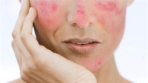 How To Reduce Redness On Cheeks Natural Tips And Remedies