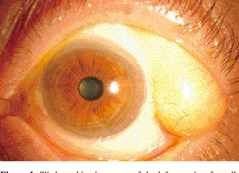 Figure 5 From Subconjunctival Orbital Fat Herniation Mimicking