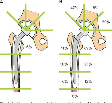 Pdf Total Hip Arthroplasty Around The Inception Of The Interface