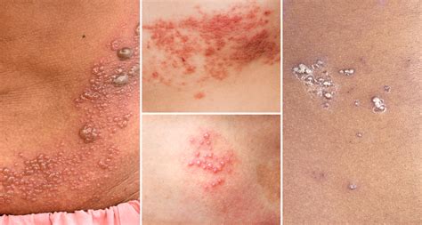 Chickenpox And Shingles During And After Pregnancy