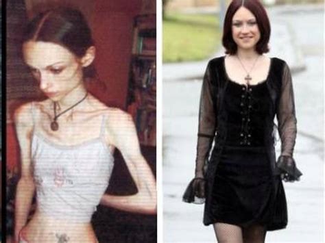 15 Amazing Girls Who Beat Anorexia Gallery Ebaums World