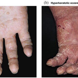 Eczematous Dermatitis Histopathology
