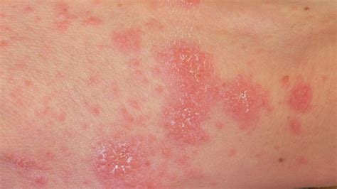 While some hard or pea sized lumps can be normal and mostly goes away on their rashes associated with allergies can cause multiple small, itchy lumps that can spread over the body or may be localized in an area such as the groin. Rash on Genitals: Causes, Treatments, and Prognosis
