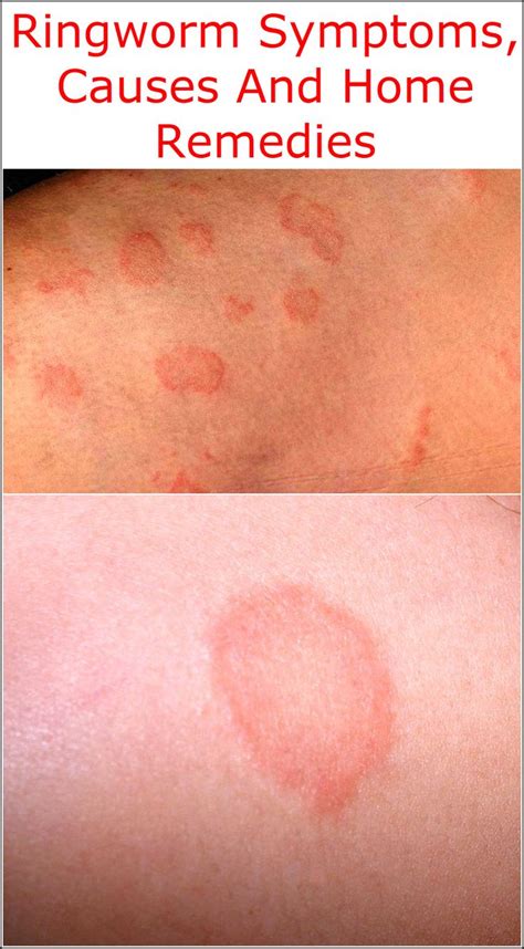 What Is Ringworm Symptoms Ndaorug