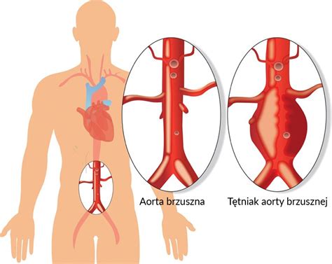 Bezp Atne Badanie Usg Aorty Brzusznej