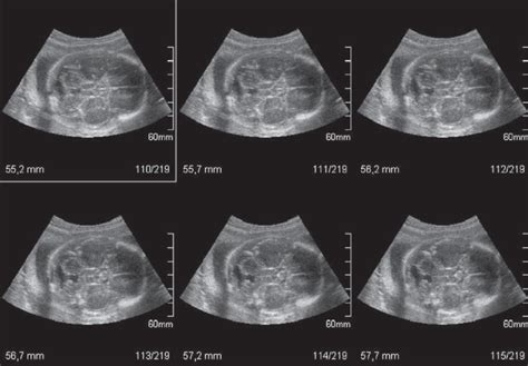 Ultrasound Of Fetal Skull In A Case Of Dandy Walker Syndrome The Msv