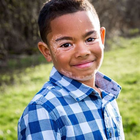 Boy With Vitiligo Meets His Special Friend With The Same Skin Disorder