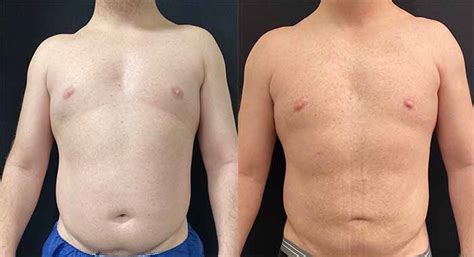 Before After Male Liposuction Results Neinstein Plastic Surgery