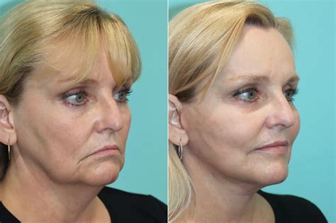 Neck Lift Before And After Photos The Naderi Center For Plastic