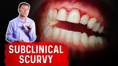 Vitamin C Deficiency Subclinical Scurvy Causes Symptoms And