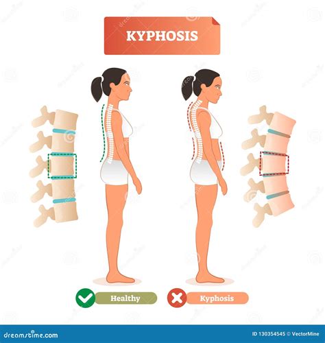 Kyphosis Vector Illustration Back Spine Defect Diagnosis Vs Healthy