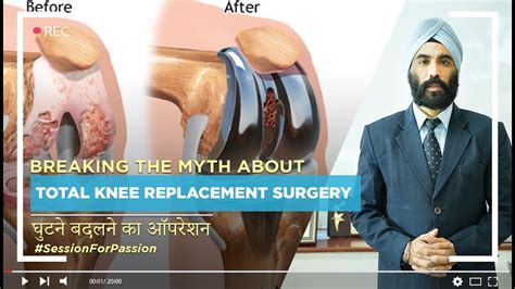 Breaking The Myth About Total Knee Replacement Surgery Dr Ips Oberoi