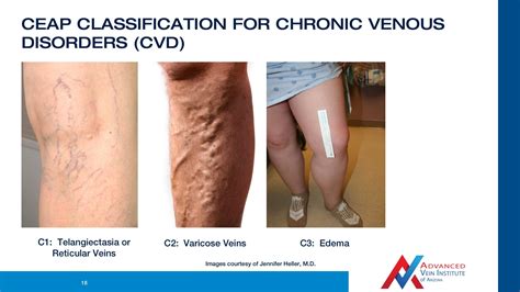 Video The Causes Of Vein Insufficiency Varicose Vein Treatment In Tempe