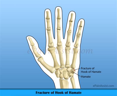 Fracture Of Hook Of Hamatecausessignssymptomstreatmentexercises