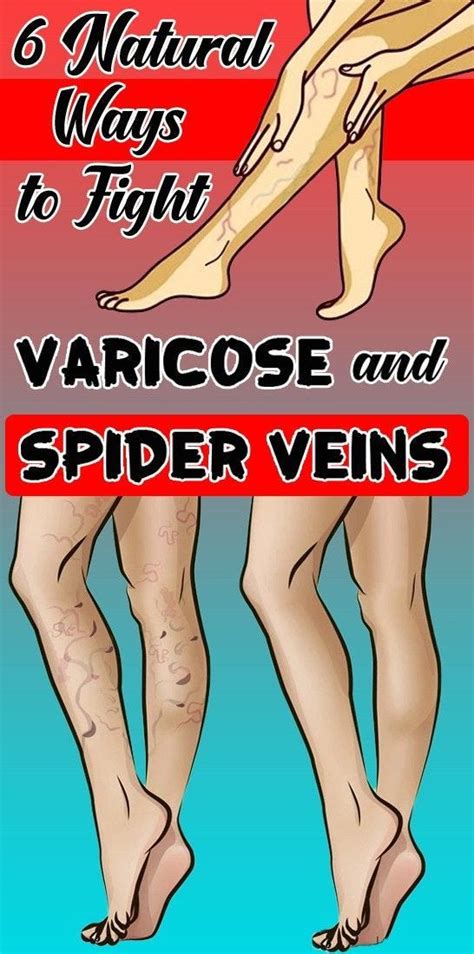 6 Natural Ways To Fight Varicose And Spider Veins Isla Pearce Medium