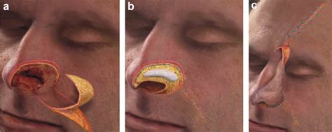 Three Layer Reconstruction Of Lower Third Nasal Defects Using Forehead Flap Reversed Nasolabial
