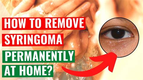 How To Remove Syringomas Permanently At Home Youtube