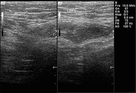 Ventral Hernia Ultrasound