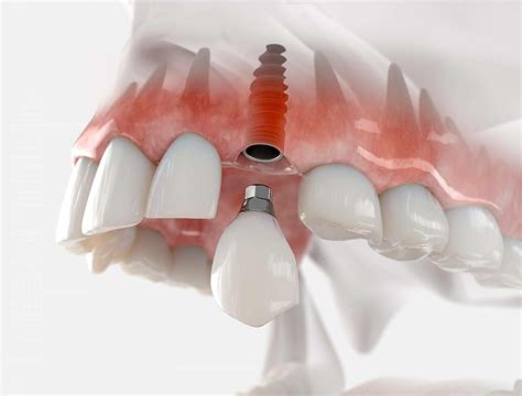 El Implante Dental De Titanio V Ha Permitido Recuperar La Masticaci N Y