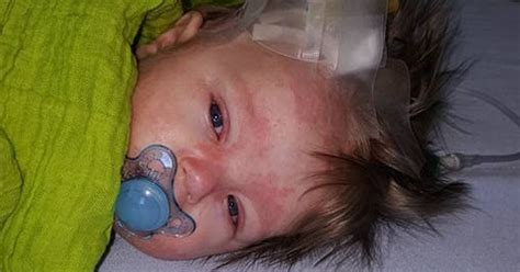 Horrifying Photos Show How Meningitis Rash Grew From A Few Dots To Cover Baby S Whole Body In