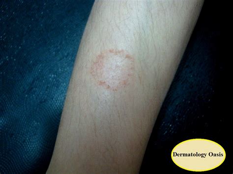 Dermatology As Related To Dermatitis Pictures