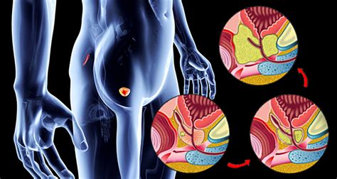 Less common symptoms can include finding blood in the urine or semen. 4 Early Warning Signs of Prostate Cancer: Understanding ...
