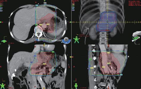 Figure 1 From Low Dose Radiation Therapy For Massive Chylous Leakage
